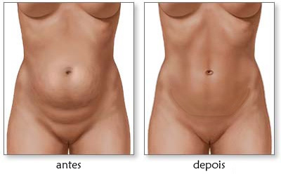 Abdominoplastia